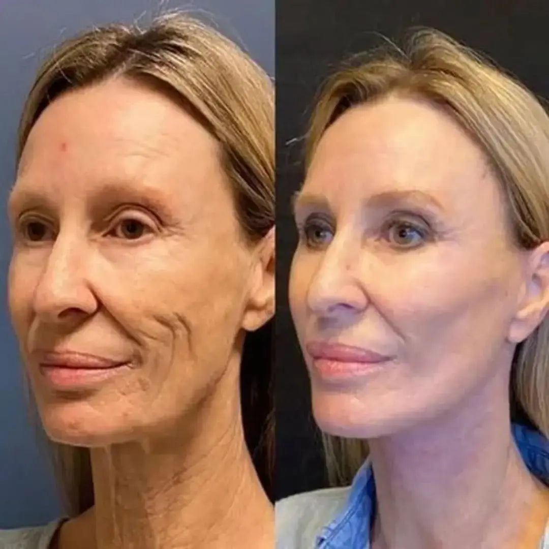 SkinLift™ Botox Serum - Synligt yngre hud på 14 dage.