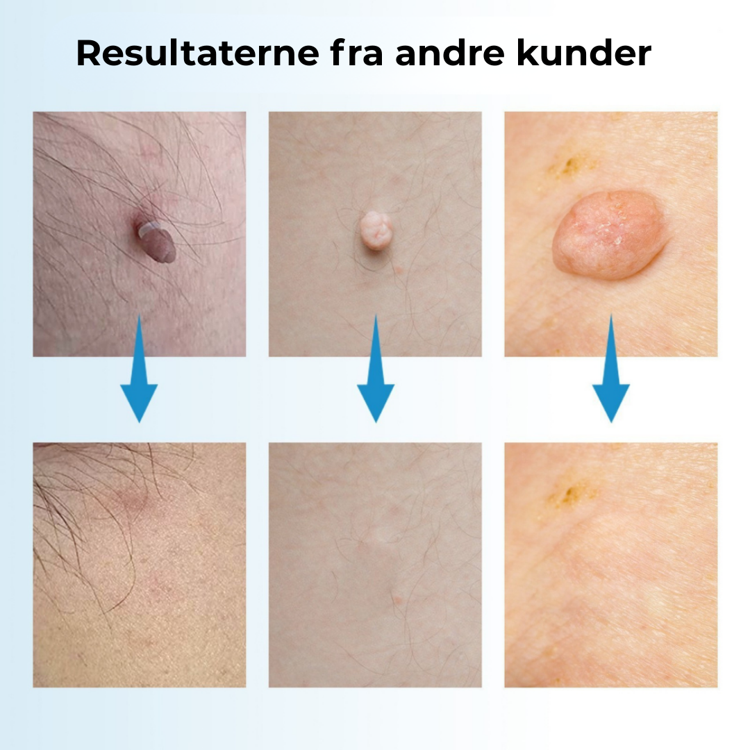 SkinEase™ Pen – Sikker fjernelse af hudmærker!