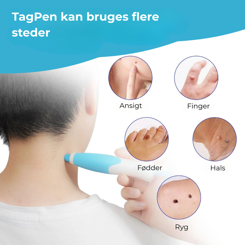 SkinEase™ Pen – Sikker fjernelse af hudmærker!